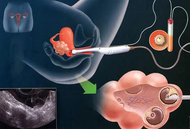 试管婴儿前如何改善卵巢功能？